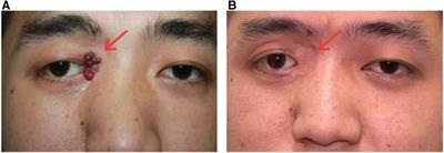 Case Report: Recurrent blepharal kaposiform hemangioendothelioma in an adult patient